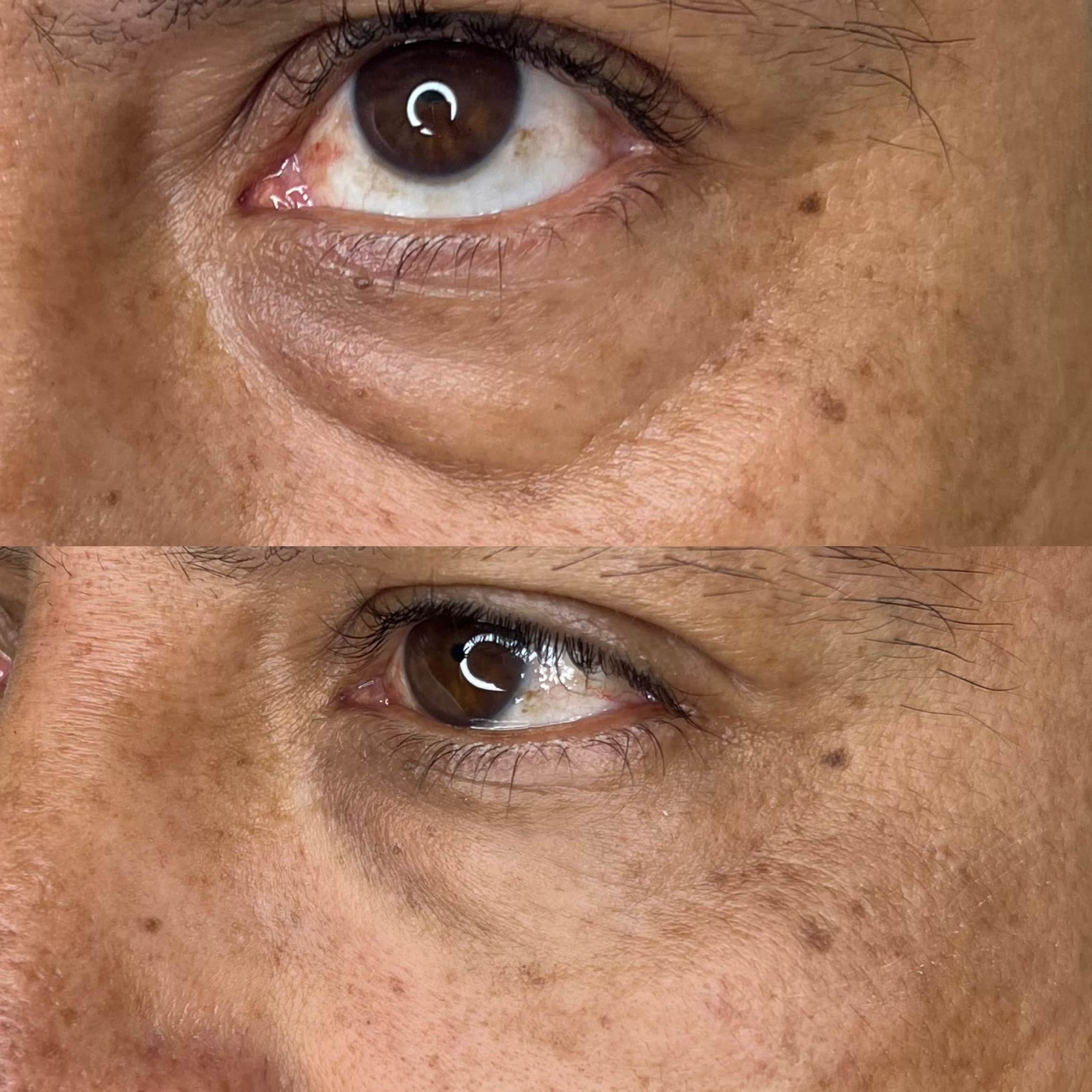 Copia de Bolsa ojeras