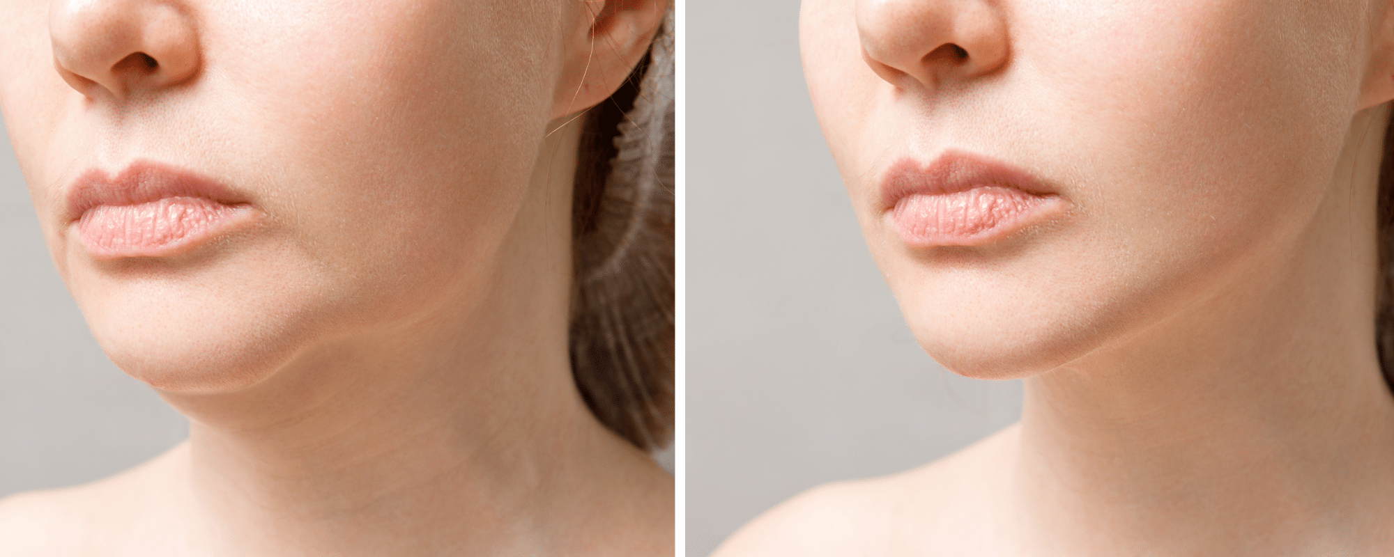 Antes y después de una armonización facial.