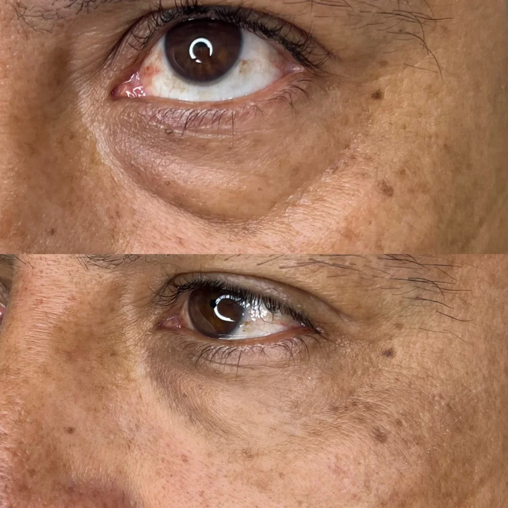 Ojeras