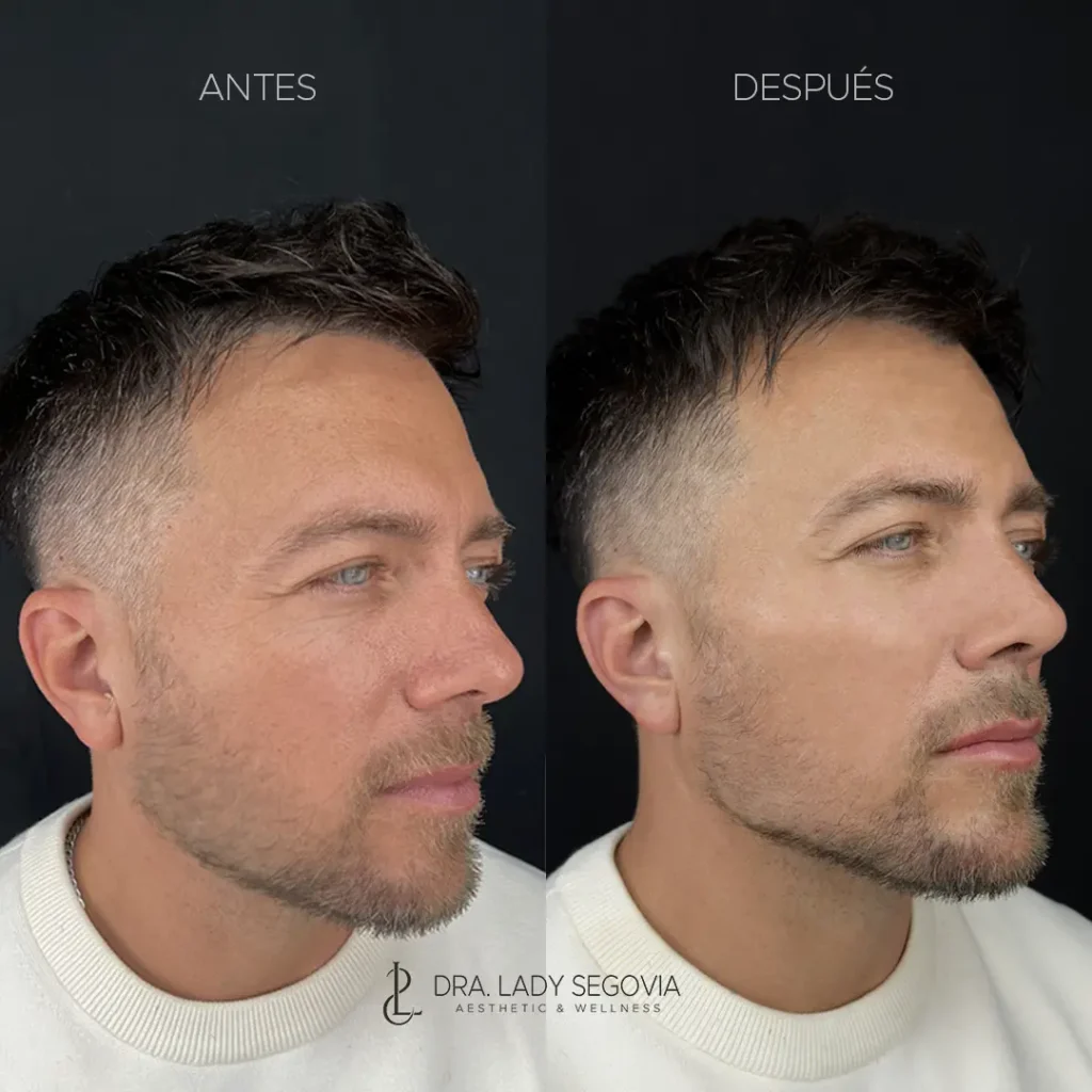 Armonización Facial - Masculinización